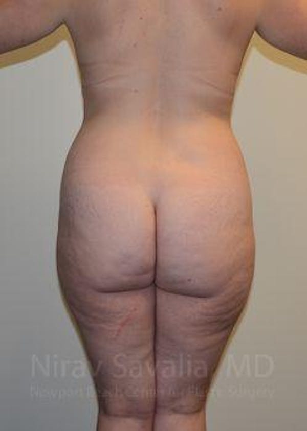 Abdominoplasty Tummy Tuck Before & After Gallery - Patient 1655670 - Before1