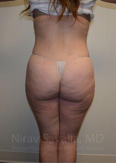 Abdominoplasty Tummy Tuck Before & After Gallery - Patient 1655670 - After1