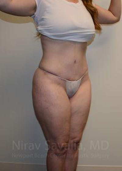 Abdominoplasty Tummy Tuck Before & After Gallery - Patient 1655670 - After1