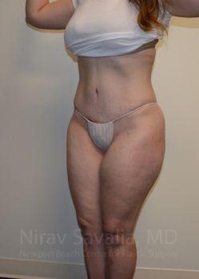 Abdominoplasty Tummy Tuck Before & After Gallery - Patient 1655670 - After1