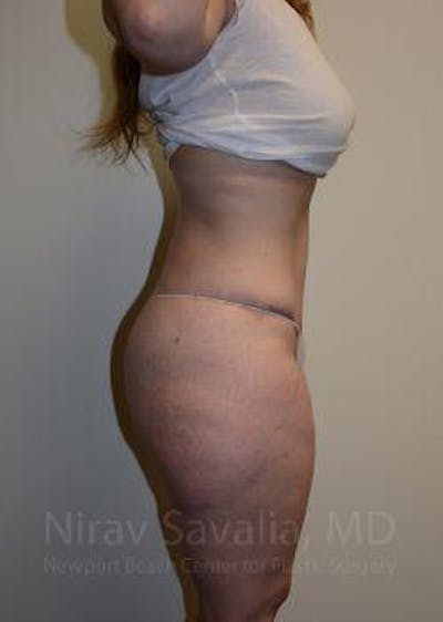 Abdominoplasty Tummy Tuck Before & After Gallery - Patient 1655670 - After1