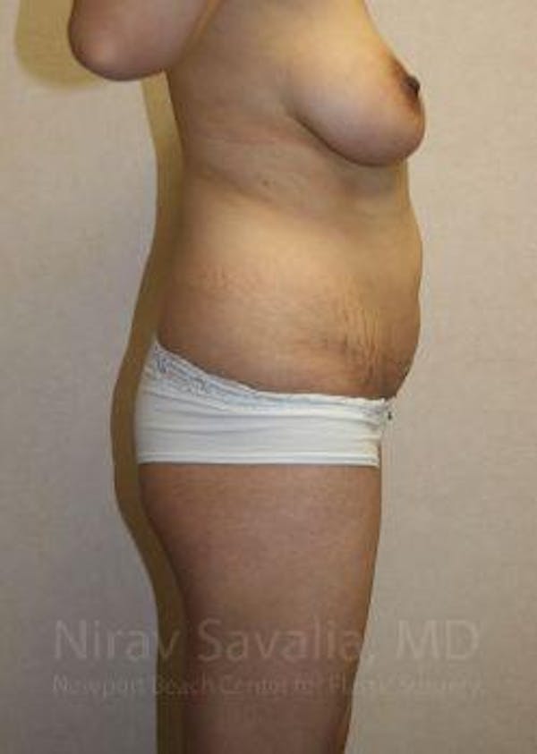 Liposuction Before & After Gallery - Patient 1655671 - Before1
