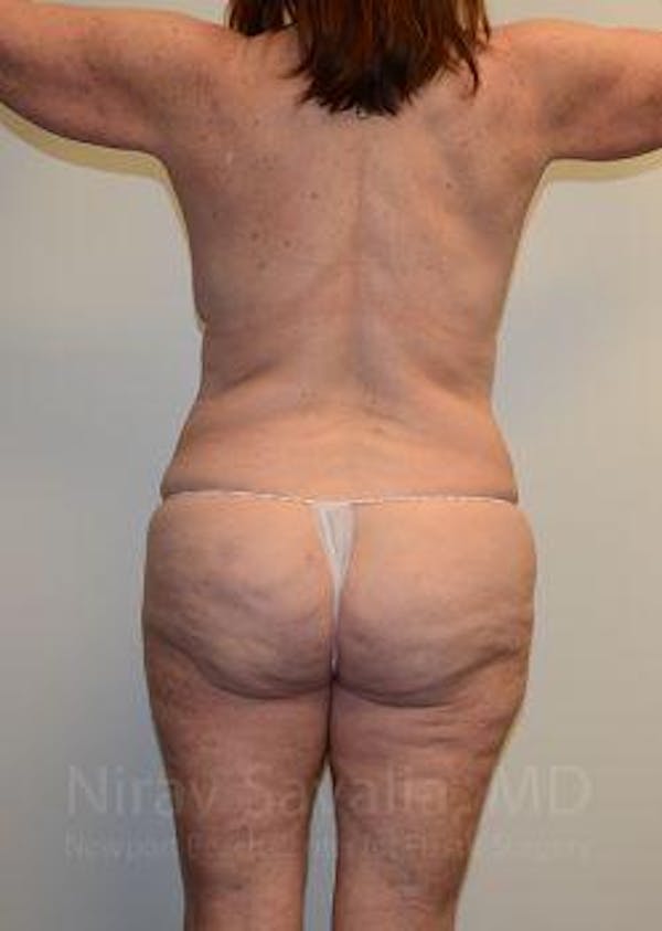 Liposuction Before & After Gallery - Patient 1655673 - Before1