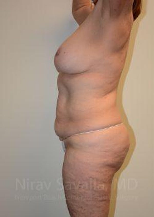 Liposuction Before & After Gallery - Patient 1655673 - Before1