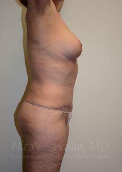 Liposuction Before & After Gallery - Patient 1655673 - After1
