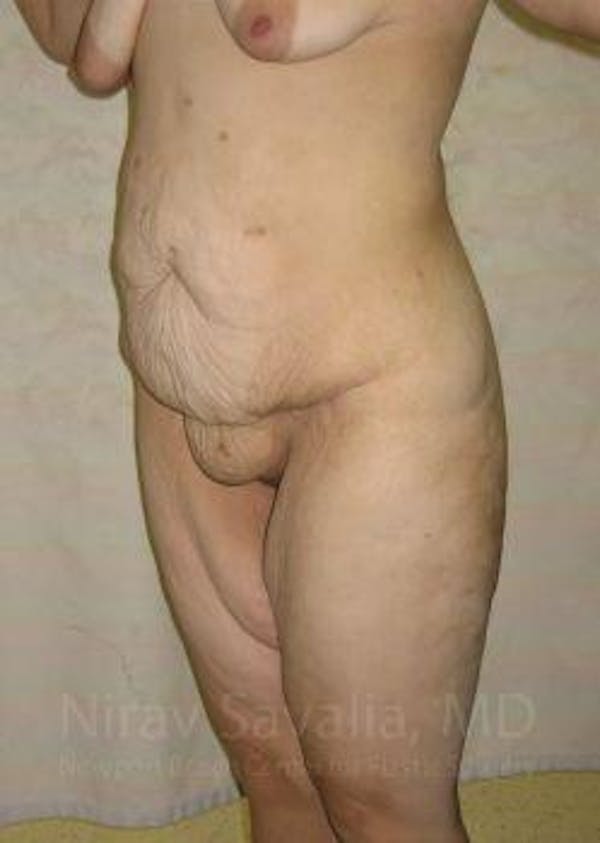 Abdominoplasty Tummy Tuck Before & After Gallery - Patient 1655677 - Before1