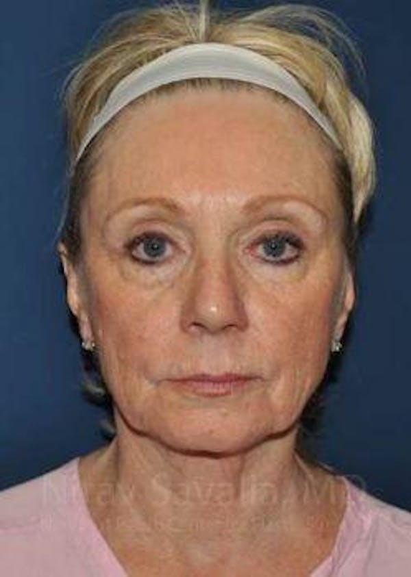 Facelift Before & After Gallery - Patient 1655682 - Before1