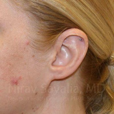 Torn Earlobe Repair Ear Gauge Repair Before & After Gallery - Patient 1655679