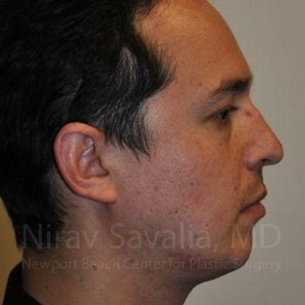 Chin Implants Before & After Gallery - Patient 1655678 - Before1