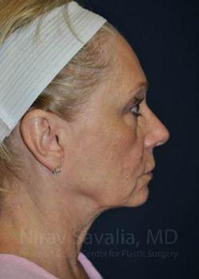 Facelift Before & After Gallery - Patient 1655682 - Before1