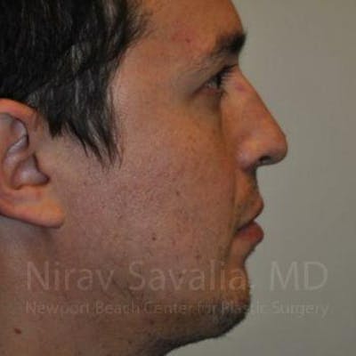 Chin Implants Before & After Gallery - Patient 1655678 - After1