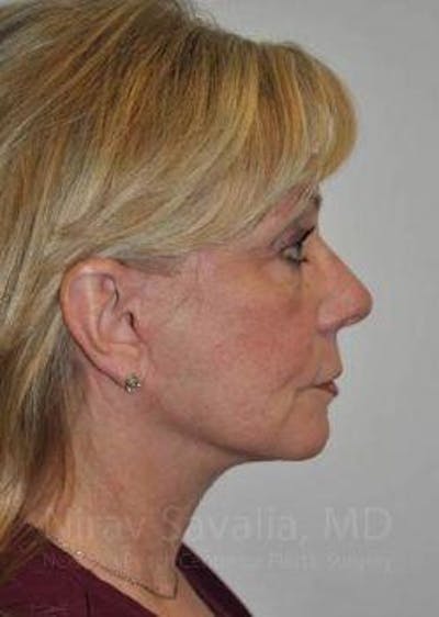 Facelift Before & After Gallery - Patient 1655682 - After1