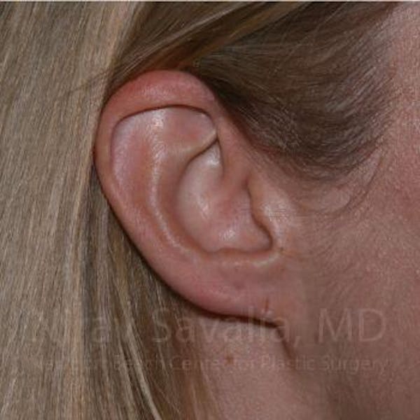 Torn Earlobe Repair Ear Gauge Repair Before & After Gallery - Patient 1655679 - Before1