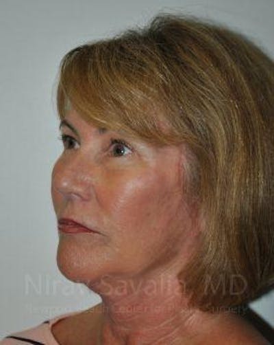 Brow Lift Before & After Gallery - Patient 1655680 - After1