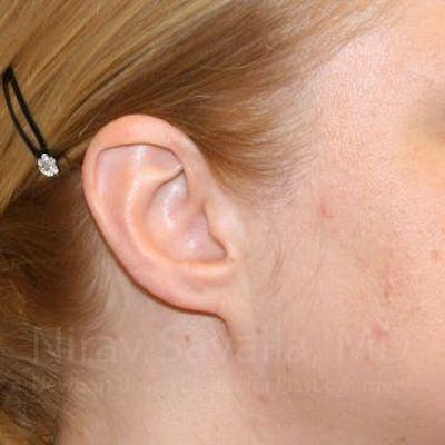 Torn Earlobe Repair Ear Gauge Repair Before & After Gallery - Patient 1655679 - After1