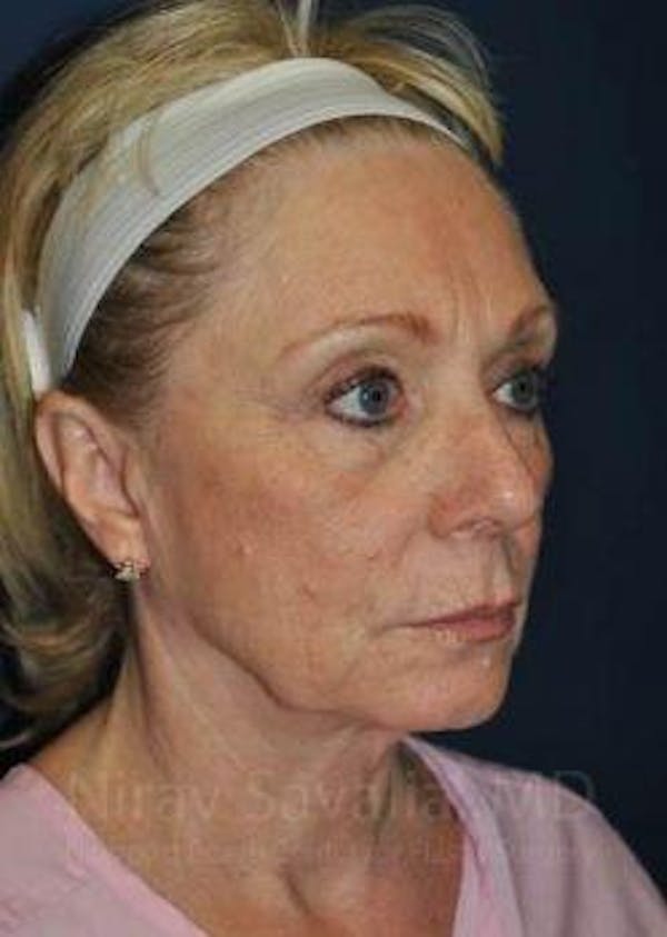Fat Grafting to Face Before & After Gallery - Patient 1655681 - Before1
