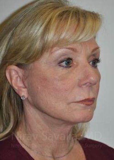 Facelift Before & After Gallery - Patient 1655682 - After1