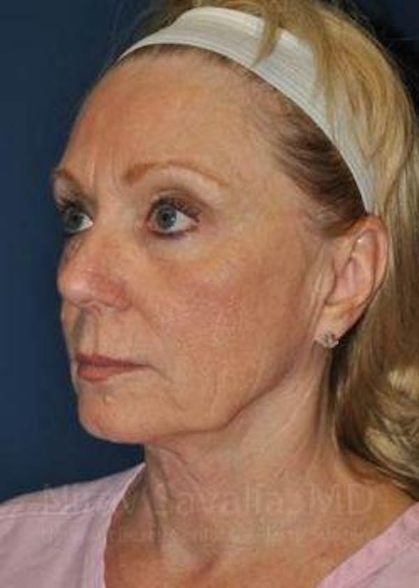 Facelift Before & After Gallery - Patient 1655682 - Before1