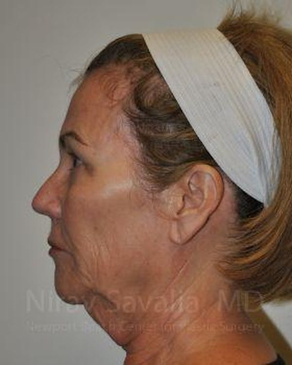 Brow Lift Before & After Gallery - Patient 1655680 - Before1