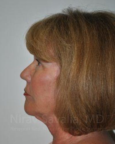 Brow Lift Before & After Gallery - Patient 1655680 - After1