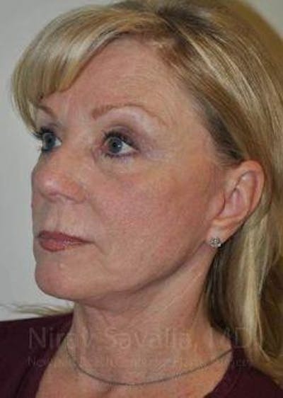 Fat Grafting to Face Before & After Gallery - Patient 1655681 - After1