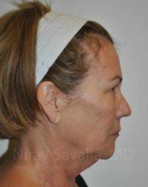 Brow Lift Before & After Gallery - Patient 1655680 - Before1