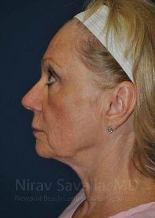 Facelift Before & After Gallery - Patient 1655682 - Before1