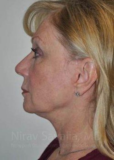 Fat Grafting to Face Before & After Gallery - Patient 1655681 - After1