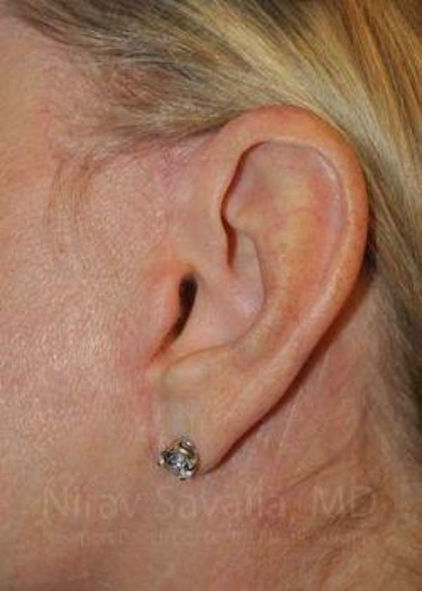 Fat Grafting to Face Before & After Gallery - Patient 1655681 - Before1