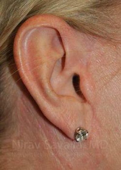 Fat Grafting to Face Before & After Gallery - Patient 1655681 - After1