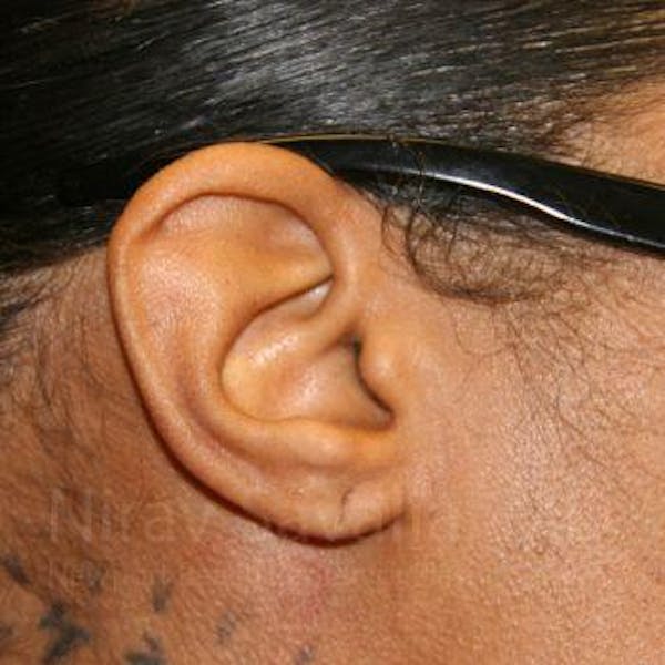 Torn Earlobe Repair Ear Gauge Repair Before & After Gallery - Patient 1655684 - Before1