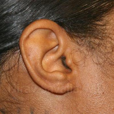 Torn Earlobe Repair Ear Gauge Repair Before & After Gallery - Patient 1655684 - After1