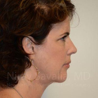 Fat Grafting to Face Before & After Gallery - Patient 1655688 - After1