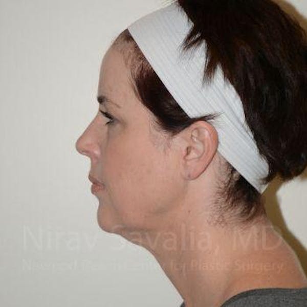 Fat Grafting to Face Before & After Gallery - Patient 1655688 - Before1