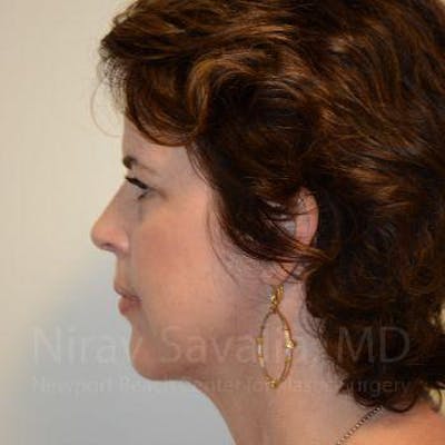 Fat Grafting to Face Before & After Gallery - Patient 1655688 - After1