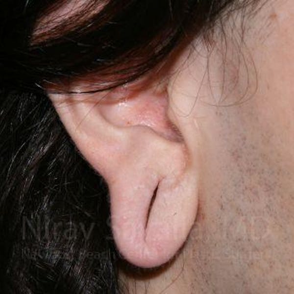 Torn Earlobe Repair Ear Gauge Repair Before & After Gallery - Patient 1655686 - Before1