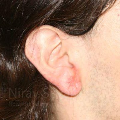 Torn Earlobe Repair Ear Gauge Repair Before & After Gallery - Patient 1655686 - After1