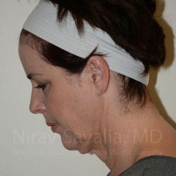 Fat Grafting to Face Before & After Gallery - Patient 1655688 - Before1
