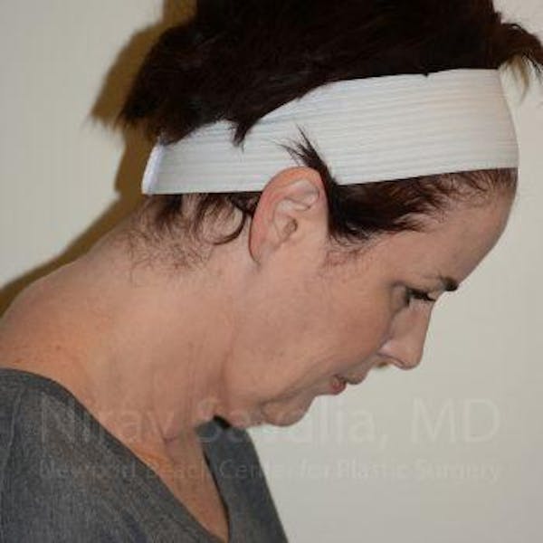 Fat Grafting to Face Before & After Gallery - Patient 1655688 - Before1