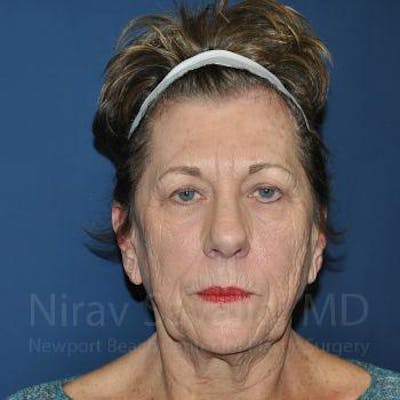 Brow Lift Before & After Gallery - Patient 1655696
