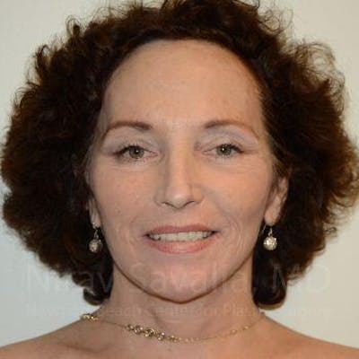 Fat Grafting to Face Before & After Gallery - Patient 1655693