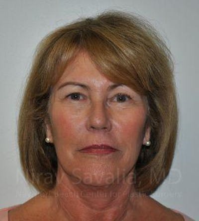 Facelift Before & After Gallery - Patient 1655695 - After1