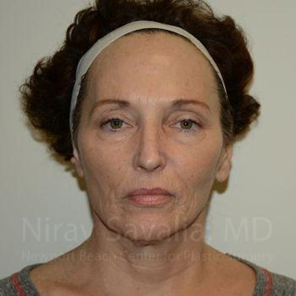 Fat Grafting to Face Before & After Gallery - Patient 1655693 - Before1