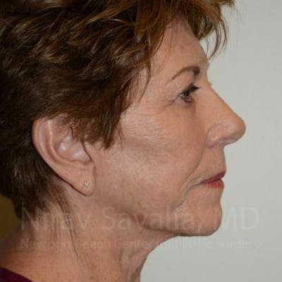 Brow Lift Before & After Gallery - Patient 1655696 - After1