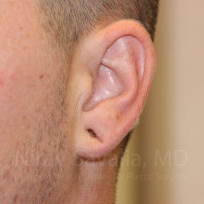 Torn Earlobe Repair Ear Gauge Repair Before & After Gallery - Patient 1655692