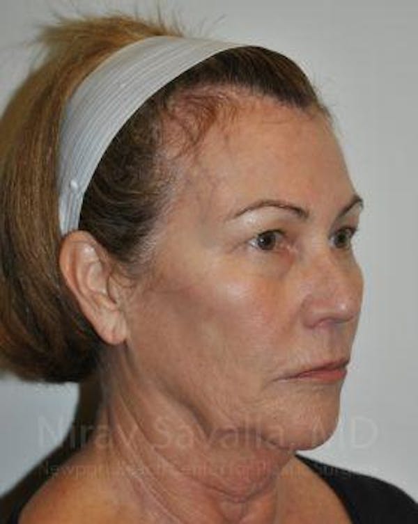Facelift Before & After Gallery - Patient 1655695 - Before1