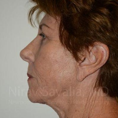 Brow Lift Before & After Gallery - Patient 1655696 - After1