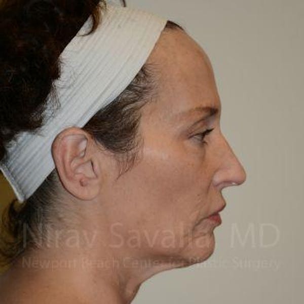 Fat Grafting to Face Before & After Gallery - Patient 1655693 - Before1