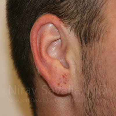 Torn Earlobe Repair Ear Gauge Repair Before & After Gallery - Patient 1655692 - After1