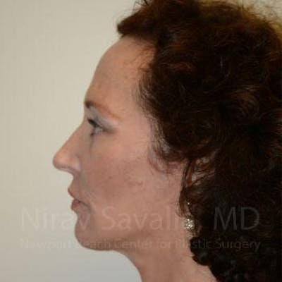 Fat Grafting to Face Before & After Gallery - Patient 1655693 - After1